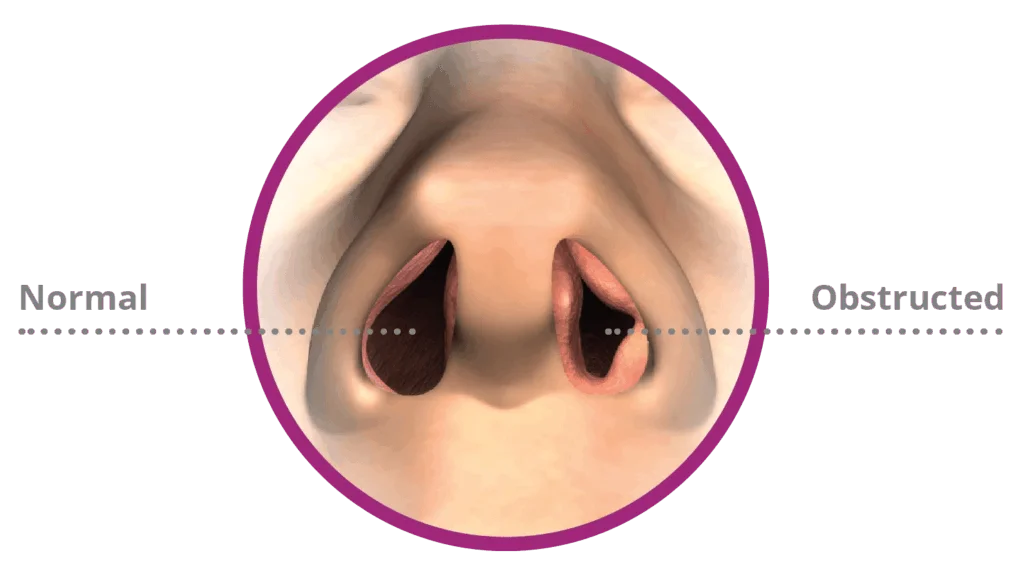 Nasal Obstruction