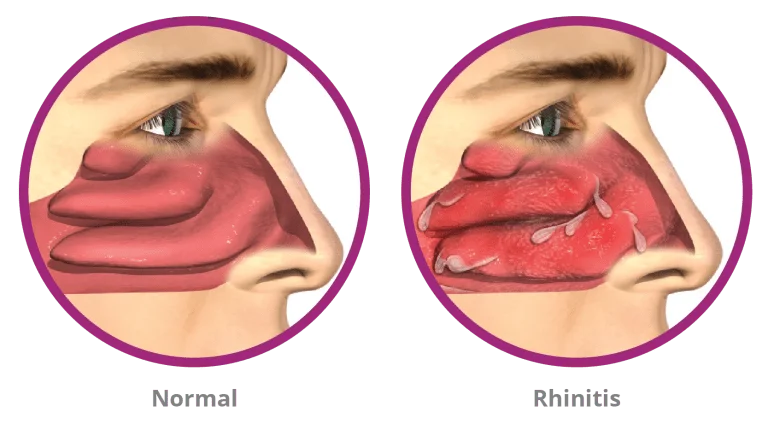 normal vs rhinitis