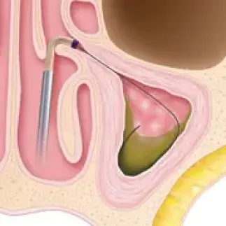 Sinusplasty surgery step 1