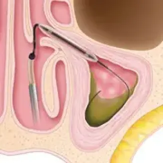 Sinusplasty surgery step 2