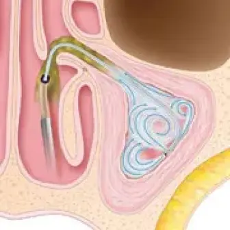 Sinuplasty Surgery Step 3