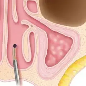 Sinuplasty Surgery Step 4